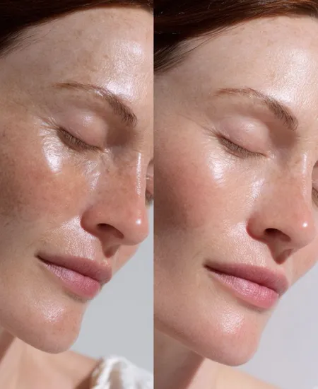 Pigmentation Treatment