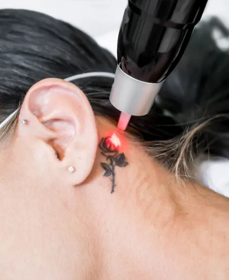 Tattoo Removal Results
