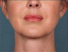 After Face Mesotherapy