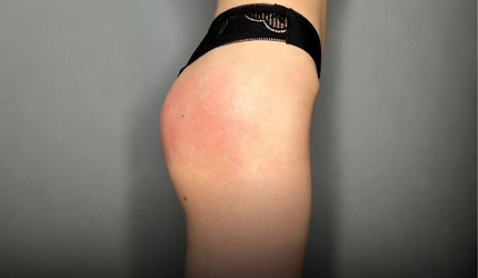 After Buttocks Filler