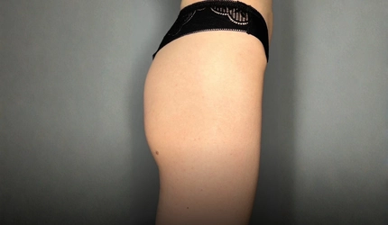 Before Buttocks Filler