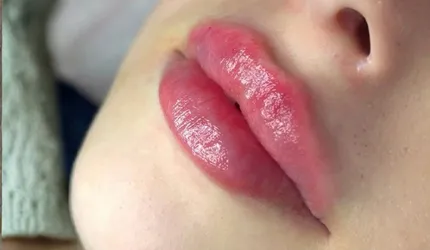 After Lip Fillers