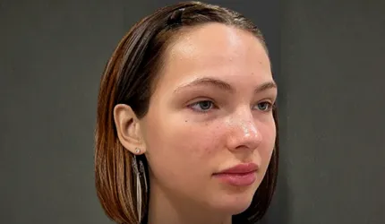 After Hair Mesotherapy