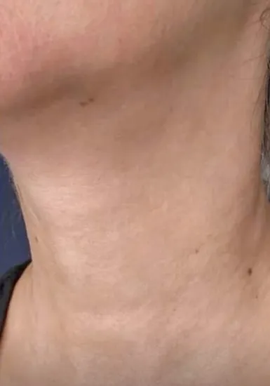 After Masseter Botox