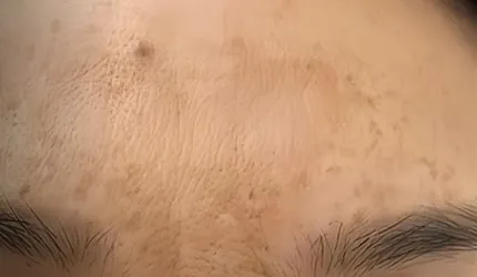 Before Pigmentation Treatment