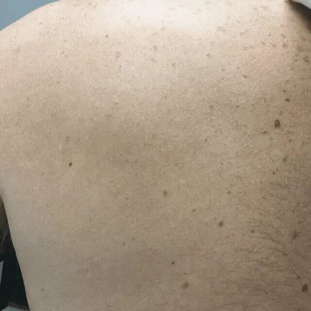 After Tattoo Removal