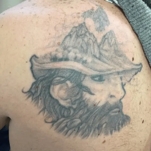 Before Tattoo Removal