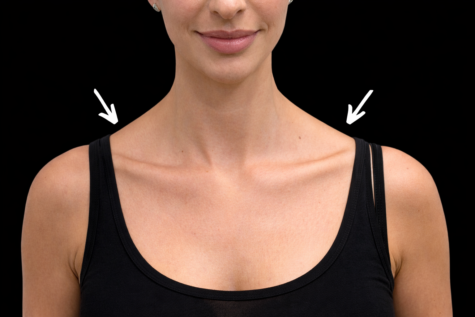 After Trapezius Botox
