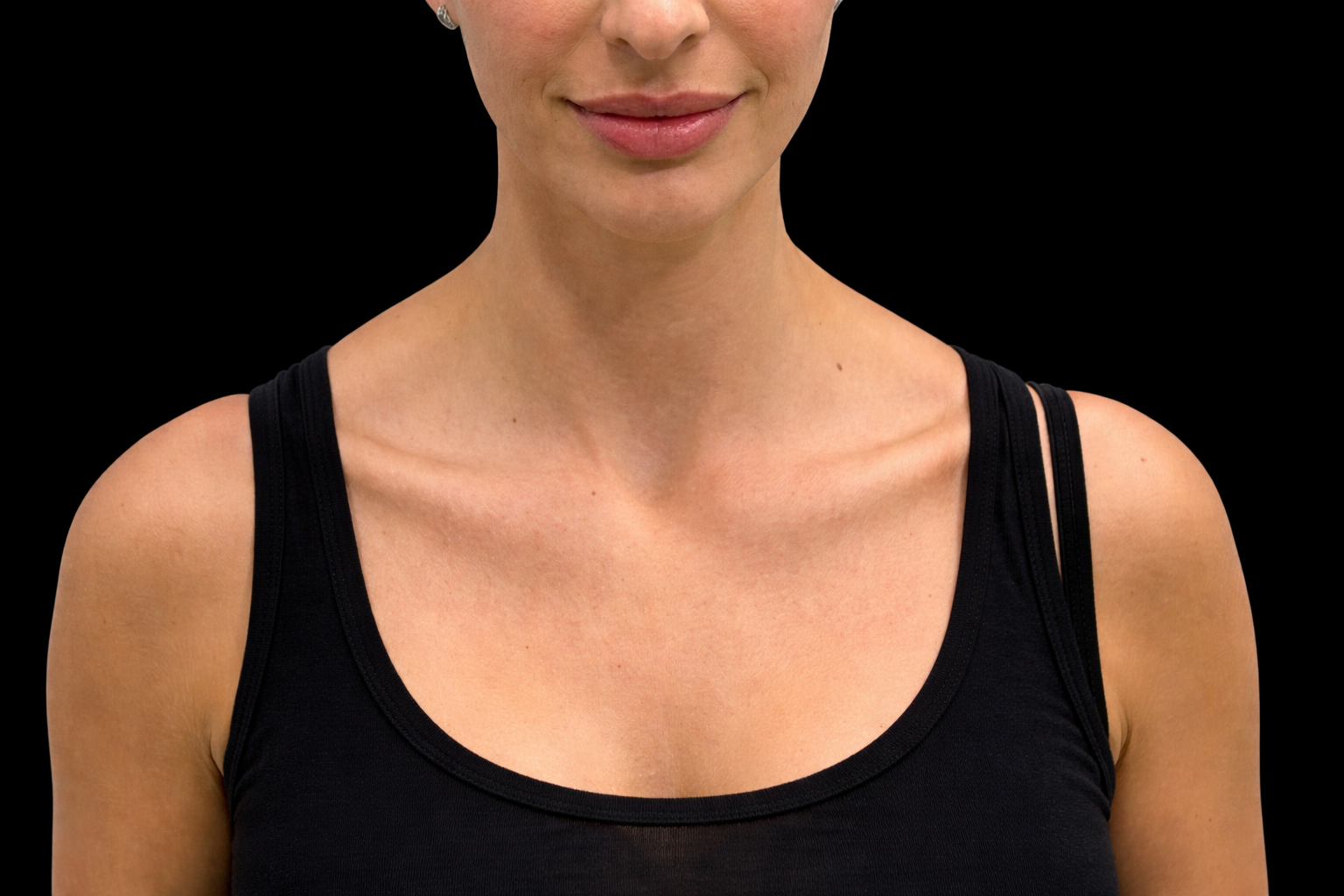 Before Trapezius Botox